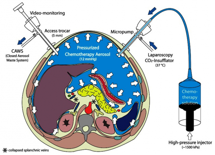 FIG 1: PIPAC SCHEMA DI TRATTAMENTO