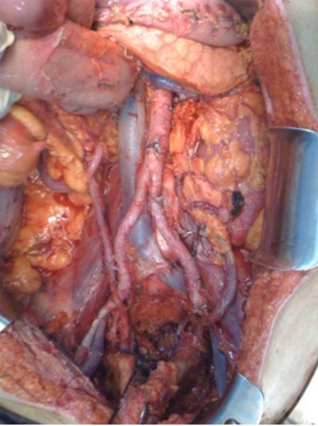 Per Saperne Di Piu Su Metastasi Peritoneali Da Carcinoma